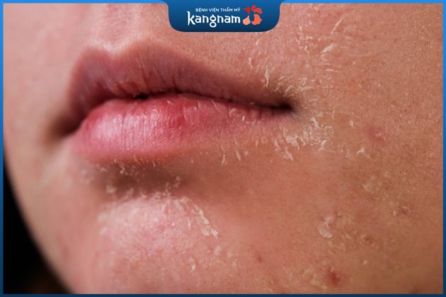 Bong tróc là hiện tượng bình thường sau lăn kim