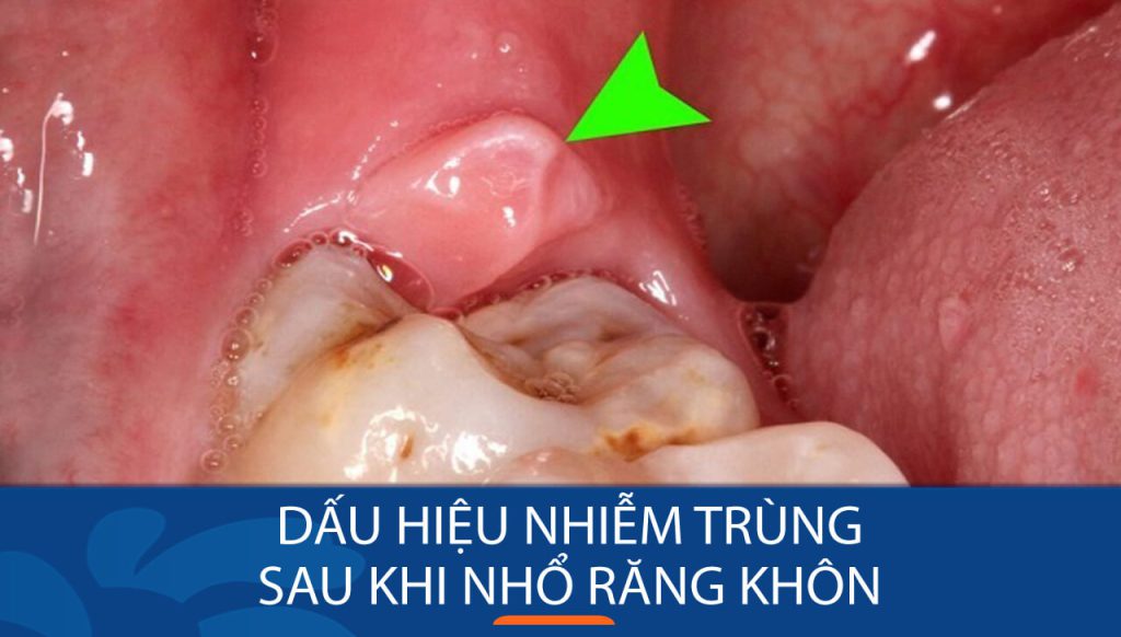 8 Dấu hiệu nhiễm trùng sau khi nhổ răng khôn dễ nhận biết