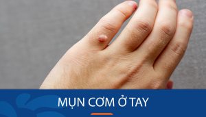 Bí quyết loại bỏ mụn cơm ở tay nhanh chóng và an toàn