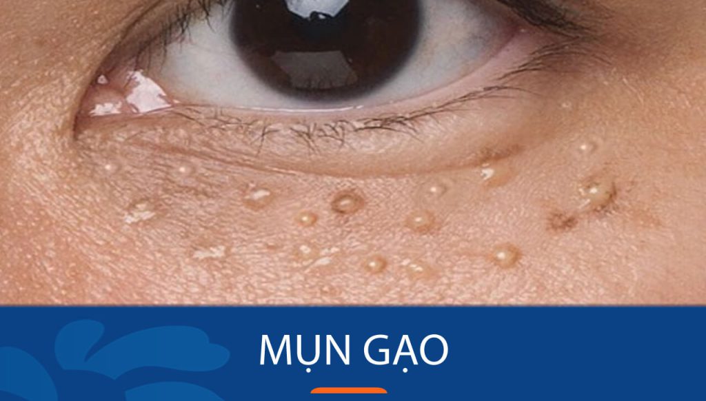 Mụn gạo: Bí quyết loại bỏ mụn triệt để