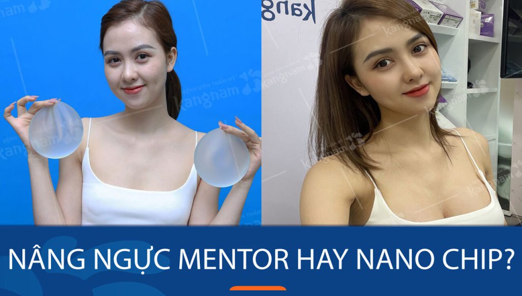 Nên chọn túi ngực Mentor hay Nano Chip? Giải đáp thắc mắc từ chuyên gia