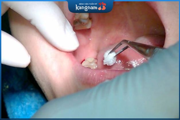 Người bệnh mắc các bệnh lý như sâu răng, viêm tủy