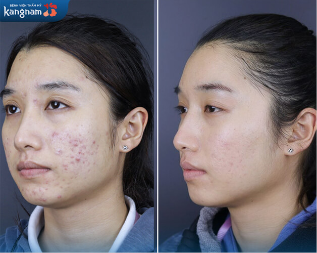 Hình ảnh trước và sau khi khách hàng trị mụn viêm, mụn bọc và thâm đỏ