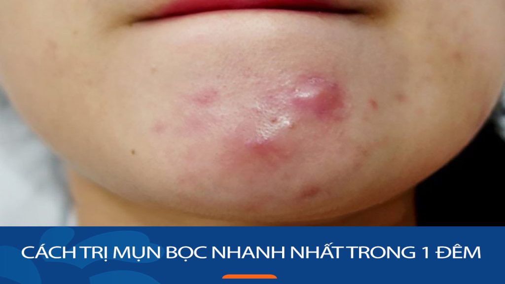 Bật mí cách trị mụn bọc nhanh nhất trong 1 đêm – An toàn, hiệu quả và không tốn kém