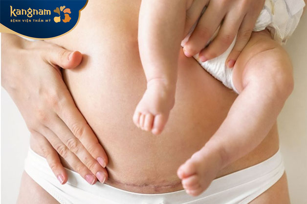 Trong lần sinh nở tiếp theo vết sẹo vẫn làm ảnh hưởng đến sức khỏe người mẹ 