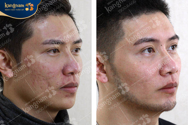 Vùng da xuất hiện sẹo rõ cải thiện sau liệu trình điều trị tại Kangnam