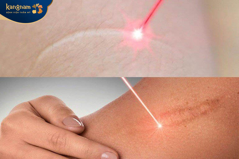Chiếu tia laser là phương pháp trị sẹo tân tiến, hiện đại