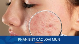 Mụn ẩn, mụn mủ, mụn bọc: Làm thế nào để phân biệt và trị đúng cách?