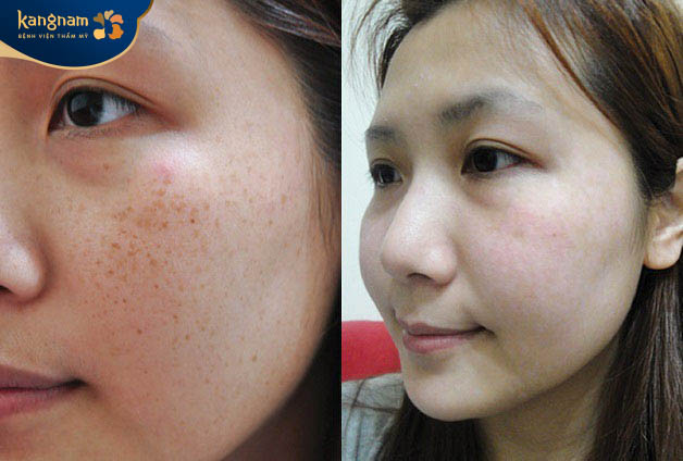 Khuôn mặt khách hàng cải thiện tàn nhang sau khi điều trị tại Kangnam