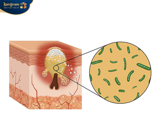 Vi khuẩn P.acnes tồn tại trên da gây ra mụn 