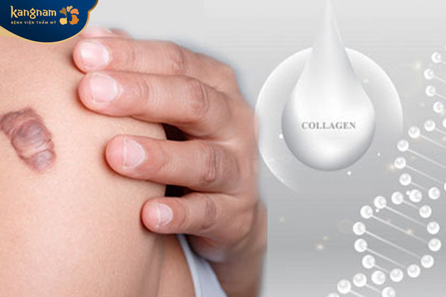 Khi da đang có sẹo lồi, tốt hơn bạn không nên bổ sung thêm collagen