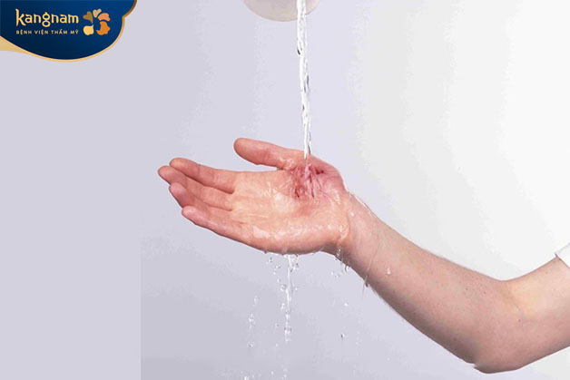Rửa nước muối sinh lý là cách làm vết thương hở mau lành an toàn 