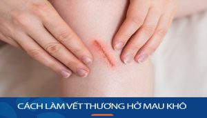 Cách làm vết thương hở mau khô, hiệu quả tức thì