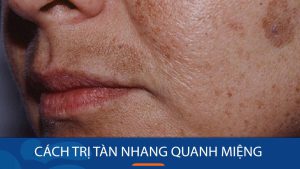 Cách trị tàn nhang quanh miệng hiệu quả, an toàn