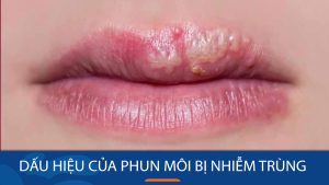 Dấu hiệu của phun môi bị nhiễm trùng và cách xử lý hiệu quả