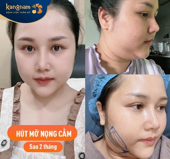 Hình ảnh khách hàng trước và sau khi hút mỡ tại Bệnh viện thẩm mỹ Kangnam