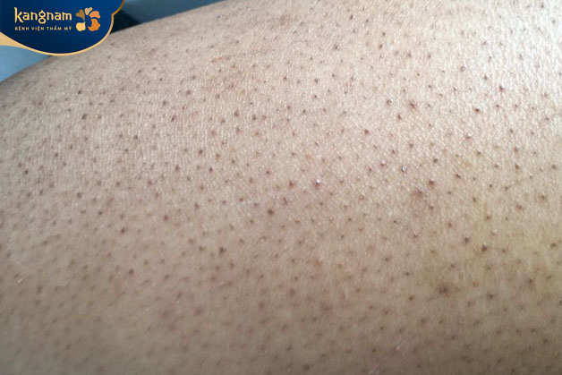 Viêm nang lông là vấn đề phổ biến ở da