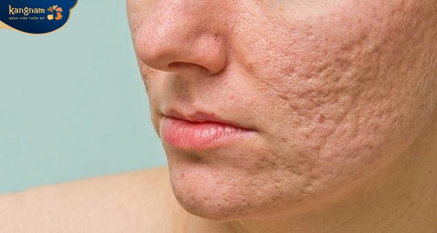 Lựa chọn kem trị sẹo rỗ dựa trên mức độ sẹo trên da