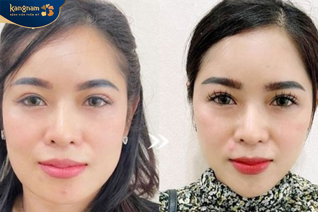 Chị Thu Quỳnh - (32 tuổi - Hà Đông) thay đổi sau tiêm botox gọn hàm