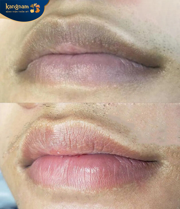 Hình ảnh khách hàng sau khi thực hiện khử thâm môi tại Bệnh viện Thẩm Mỹ Kangnam