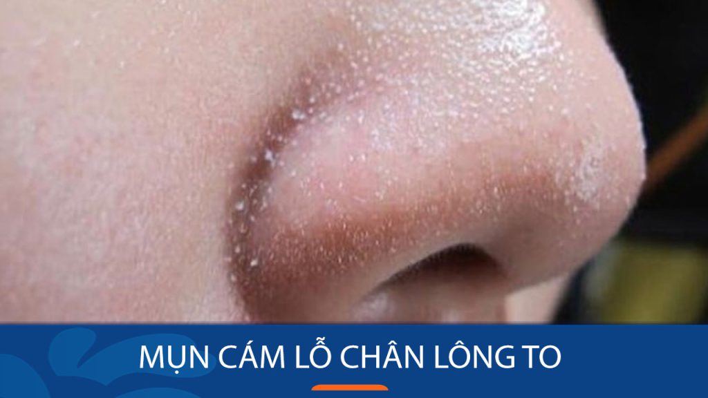 Mặt nhiều mụn cám lỗ chân lông to: Bí quyết lấy lại làn da mịn màng