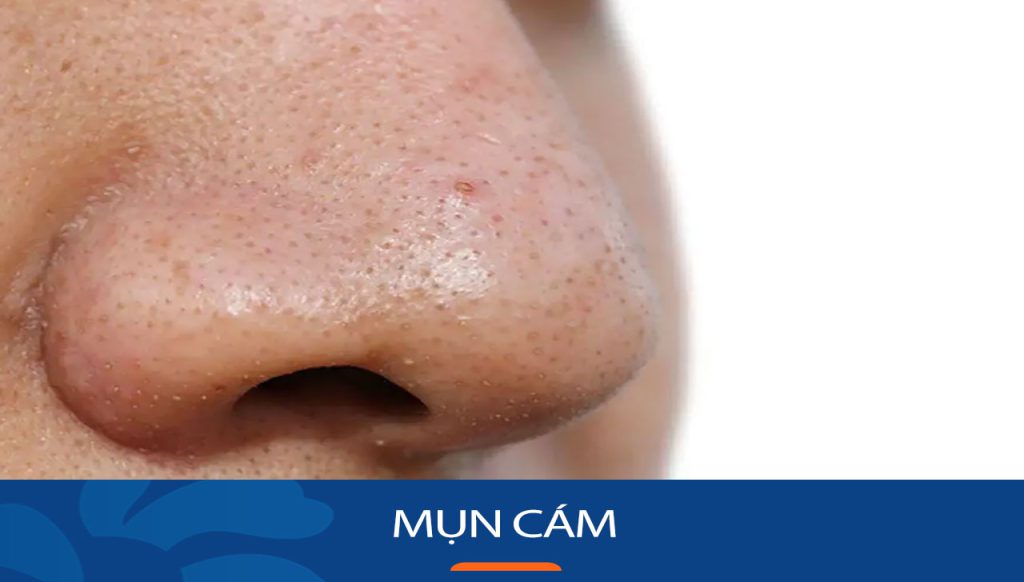 Bí Quyết Loại Bỏ Mụn Cám Vĩnh Viễn: Tạm Biệt Lỗ Chân Lông To & Da Sần Sùi