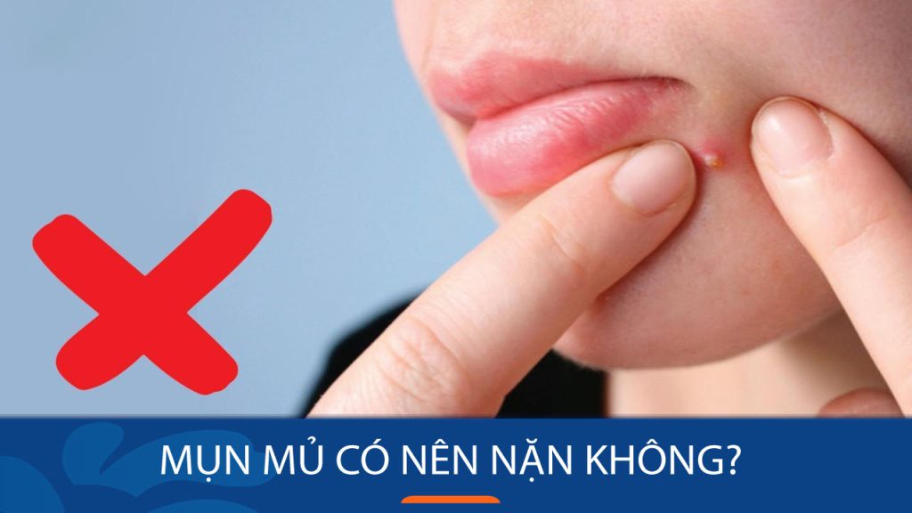 Mụn mủ có nên nặn không? Nặn mụn mủ đúng cách để da sáng mịn, không thâm sẹo