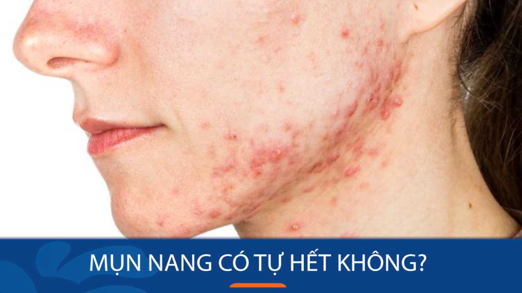 Mụn nang có tự hết không? Cách điều trị hiệu quả