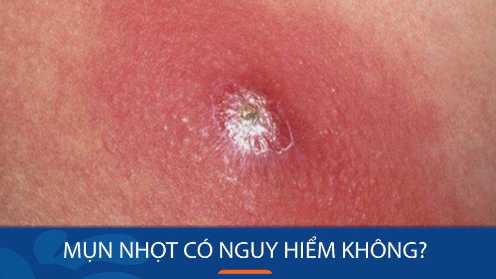 Mụn nhọt có nguy hiểm không? Đừng chủ quan, hãy bảo vệ sức khỏe của bạn!
