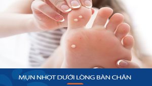 Giải pháp dứt điểm cho tình trạng mụn nhọt dưới lòng bàn chân