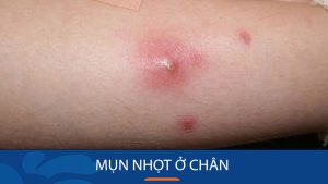 Mụn nhọt ở chân: Nguyên nhân, triệu chứng và cách điều trị