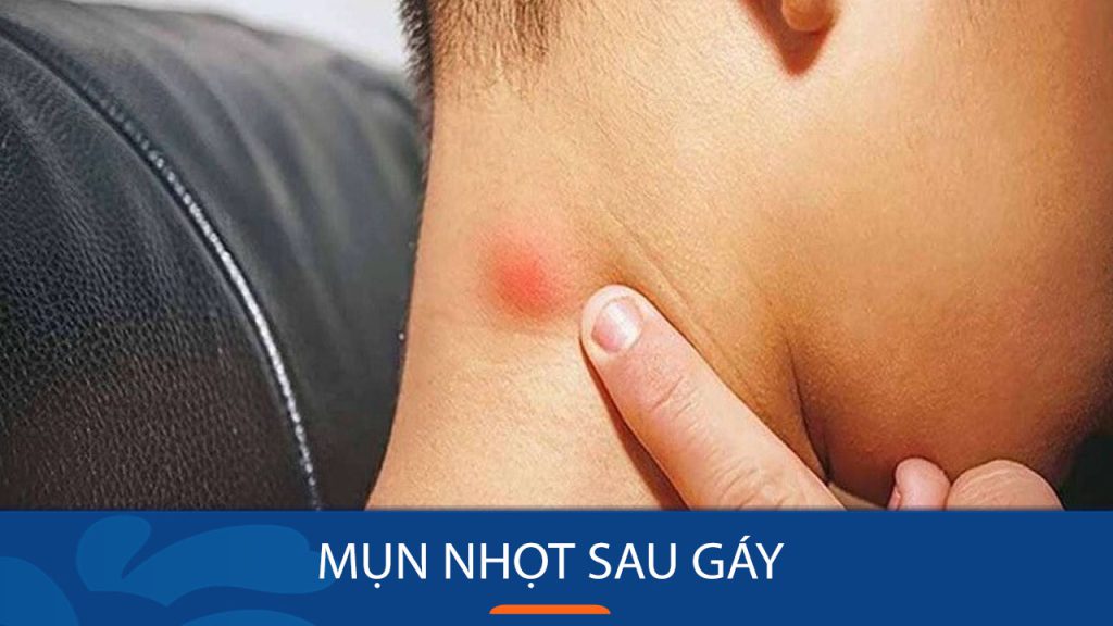 Mụn nhọt sau gáy: Bí quyết loại bỏ mụn nhọt sau gáy tận gốc