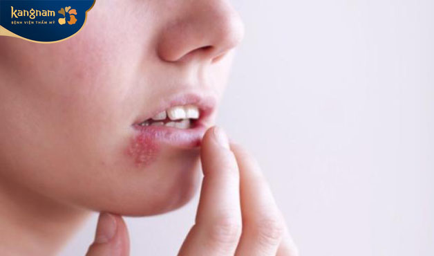 Herpes miệng lây lan do tiếp xúc trự tiếp da với da