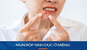 Thoát khỏi mụn rộp sinh dục ở miệng: Các biện pháp điều trị và phòng ngừa hiệu quả