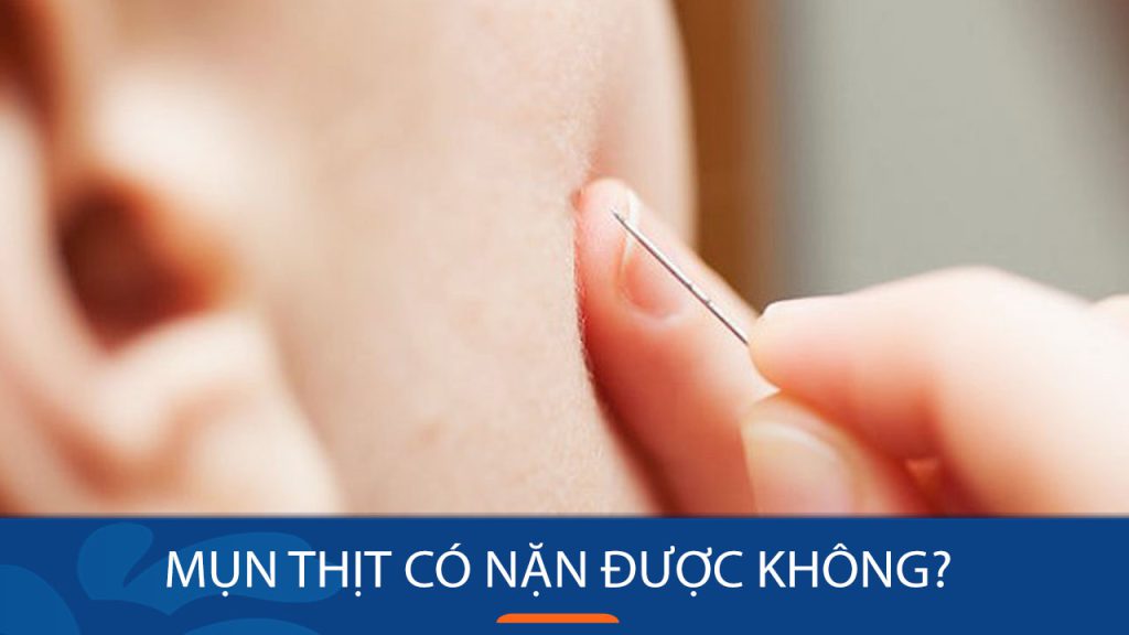 Mụn thịt nặn được không? Cách nặn mụn thịt an toàn và hiệu quả tại nhà