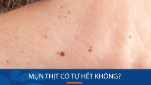 Mụn thịt có tự hết không? Bí quyết loại bỏ mụn thịt tận gốc, trả lại làn da mịn màng!