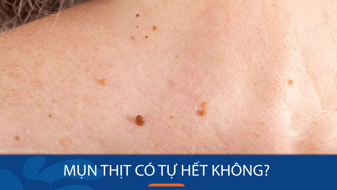 Mụn thịt có tự hết không? Bí quyết loại bỏ mụn thịt tận gốc