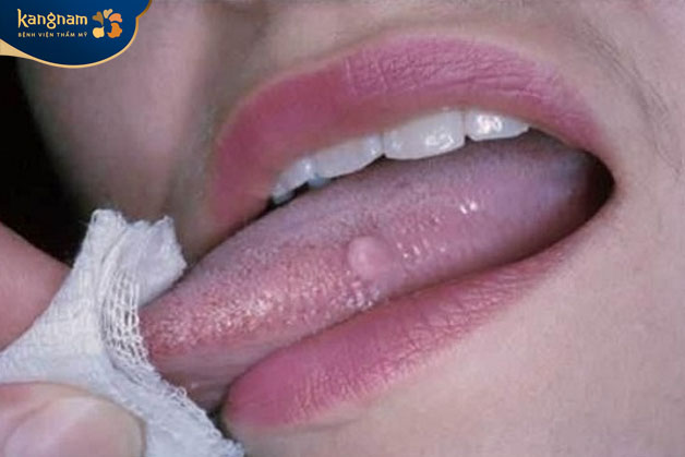 Mụn thịt trên lưỡi có thể hình thành do u xơ kích ứng