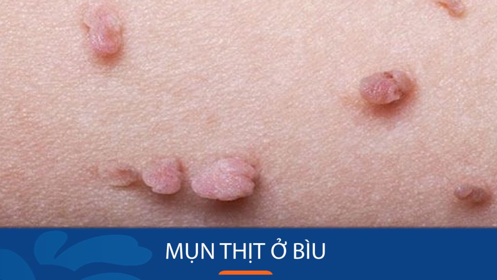 Nỗi ám ảnh “mụn thịt” ở bìu: Nguyên nhân, triệu chứng và cách xử lý