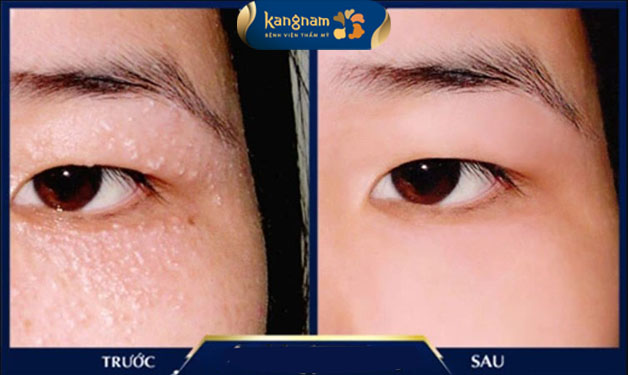 Điều trị mụn thịt ở mắt bằng phương pháp laser tân tiến nhất hiện nay