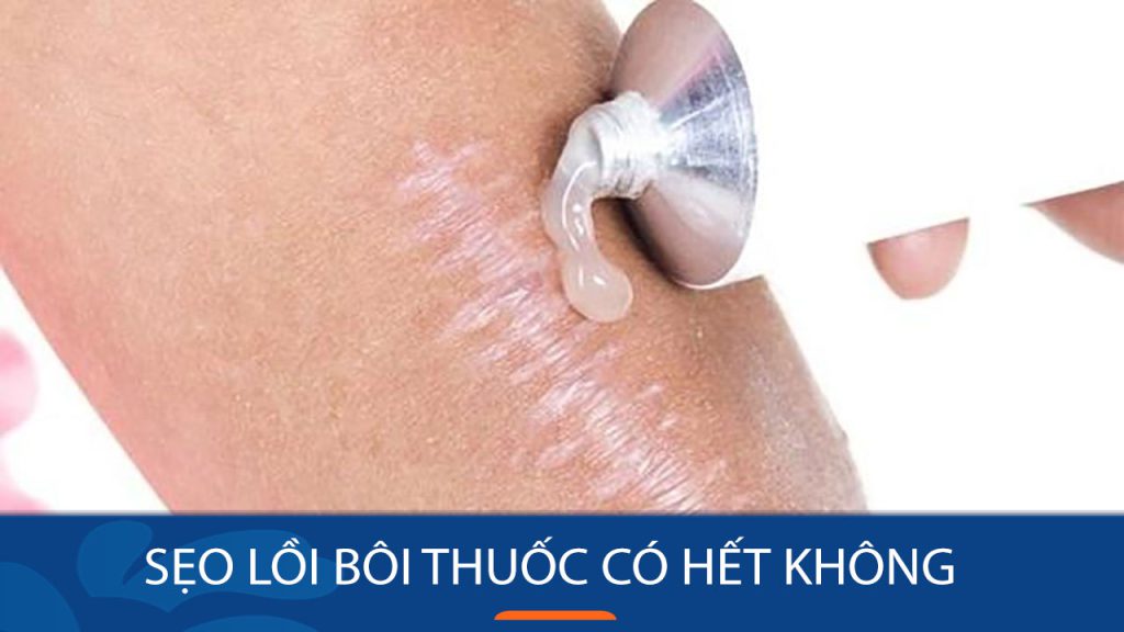 Sẹo lồi bôi thuốc có hết không? Cần lưu ý điều gì