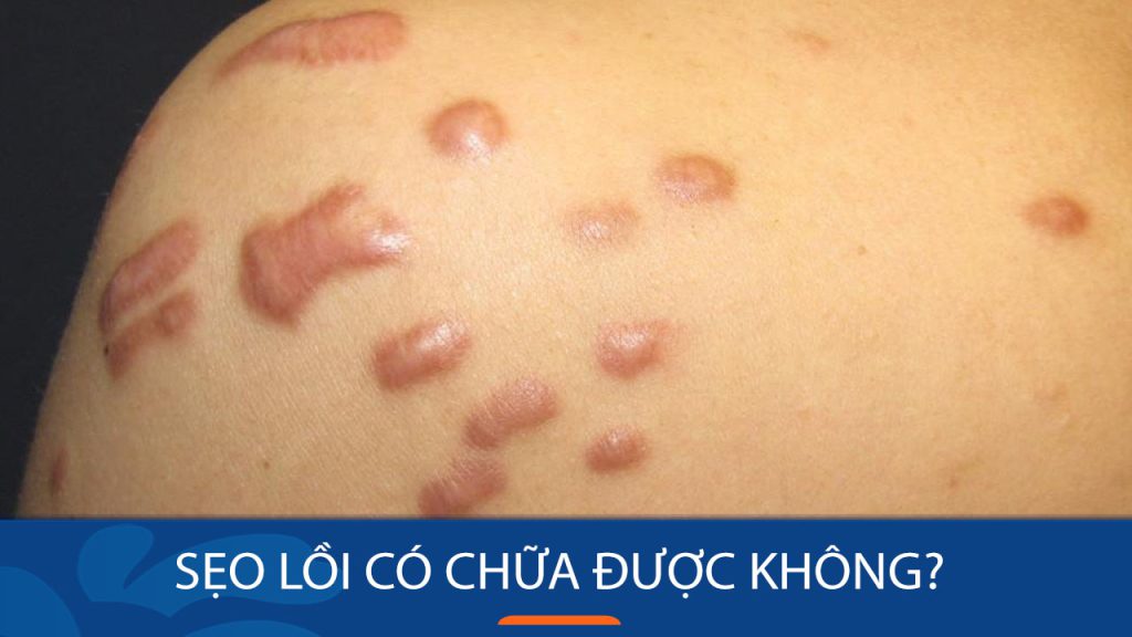 Sẹo lồi có chữa được không?Loại bỏ hoàn toàn hay chỉ giảm thiểu?