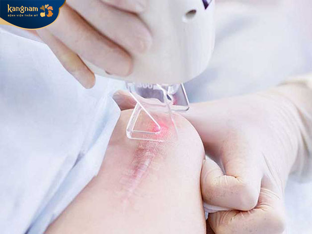 Các xung laser sẽ tác động giúp khắc phục sẹo lồi lâu năm hiệu quả