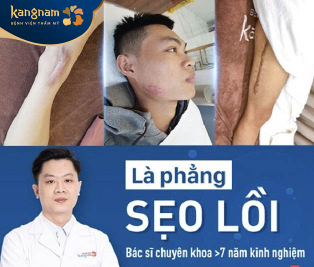 Trị sẹo lồi an toàn, chuẩn y khoa tại Bệnh viện thẩm mỹ Kangnam