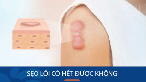 Sẹo lồi có hết được không?Loại bỏ hoàn toàn hay chỉ có thể làm mờ?