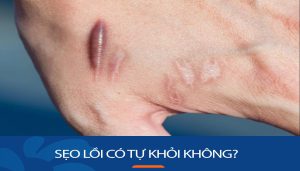 Sẹo lồi có tự khỏi không? – Bác sĩ Kangnam giải đáp