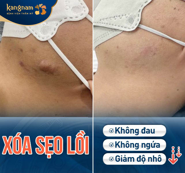 Bệnh viện thẩm mỹ Kangnam điều trị sẹo lồi bằng sóng ELLA hiệu quả