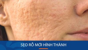 Sẹo rỗ mới hình thành có tự đầy được không? Loại bỏ hoàn toàn chỉ sau 1 liệu trình