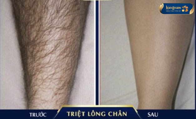 Khách hàng M.H.A triệt lông chân thành công tại Kangnam, lông chân quăn, rậm được xử lý hoàn toàn, làn da sáng mịn màng sau triệt lông.