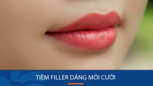 Tiêm filler môi cười: Bí quyết sở hữu nụ cười rạng rỡ